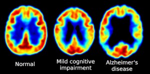 FDG-PET brain scan-normal-MCI-Alzheimers.jpg from Wikimedia Commons, Licensed by Creative Commons FDG-PET_brain_scan-normal-MCI-Alzheimers